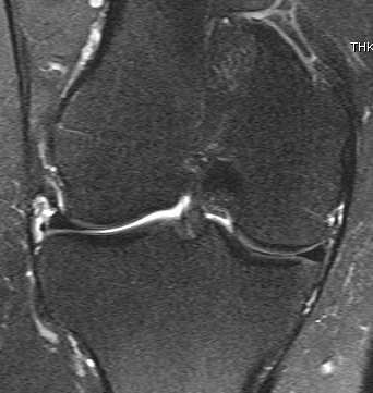 MRI Lateral Meniscal Cyst